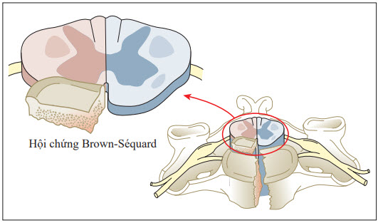 Các triệu chứng và tình trạng của bệnh nhân mắc hội chứng Brown-Séquard là như thế nào?
